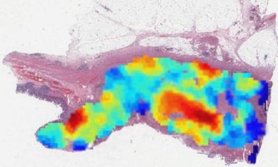 AI helps analyse colorectal cancer samples - healthcare
