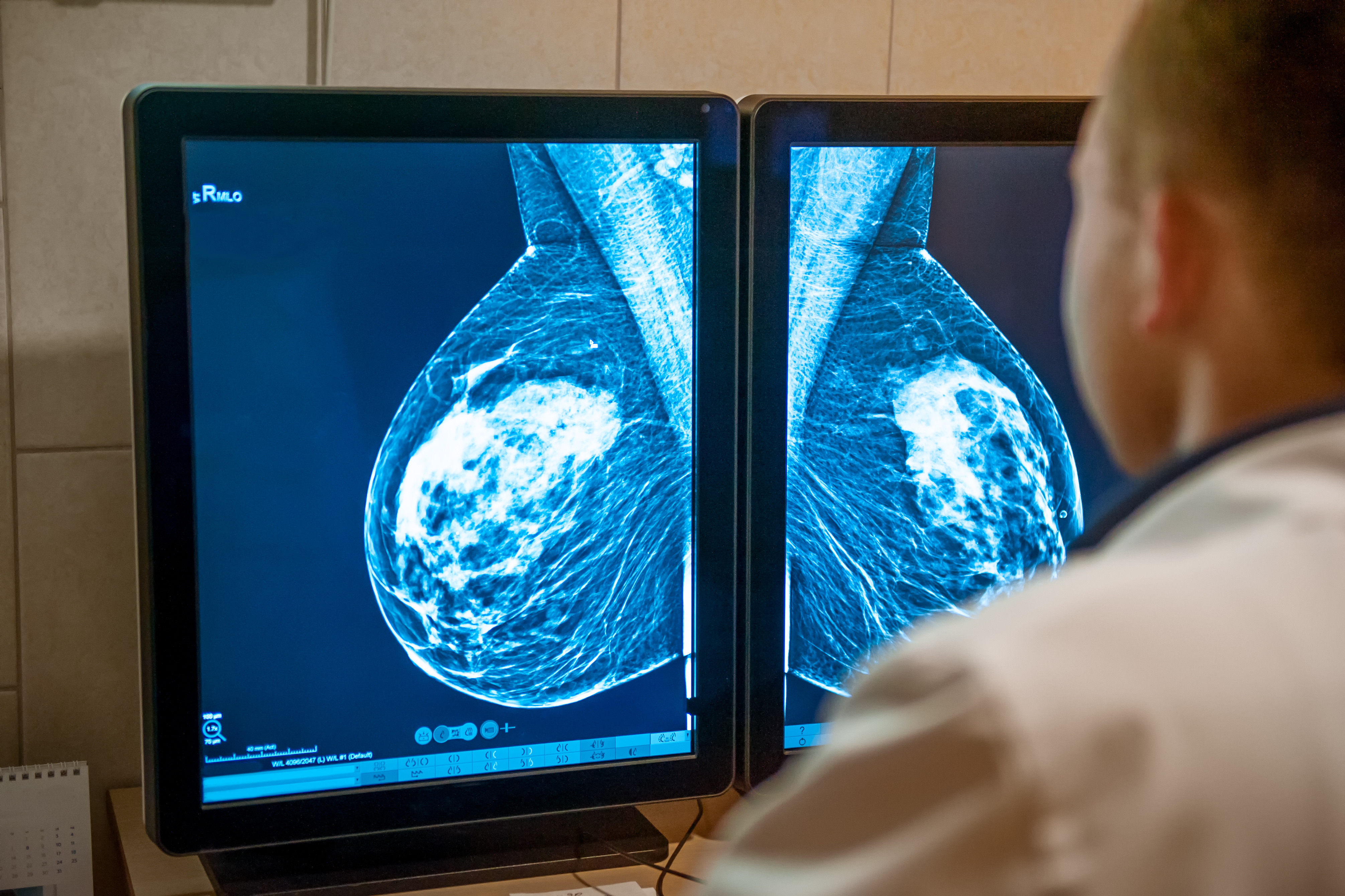 Can AI Provide an ‘Early Alert’ for Breast Cancer Before Diagnosis?