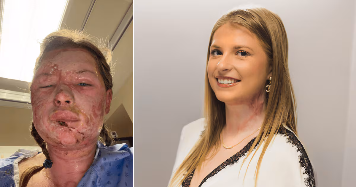 Burn experts treat woman injured during London, Ont. frat house fire using world