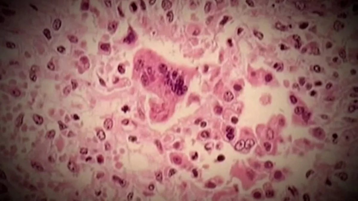 Peel Public Health investigating measles exposure on June 13