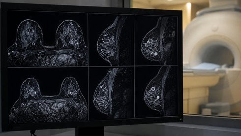 AI breakthrough could make breast cancer MRI scans faster, sharper and more accessible