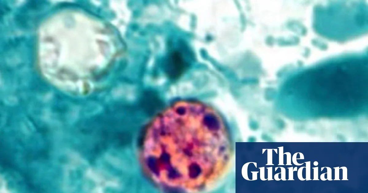 What is cyclosporiasis, the parasitic illness causing ‘explosive’ diarrhea?