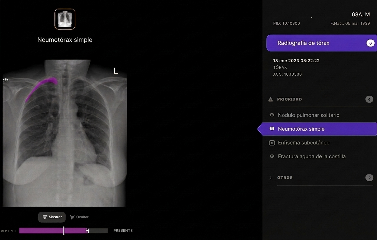 Telefónica and Harrison.ai join forces to support the diagnosis of chest X