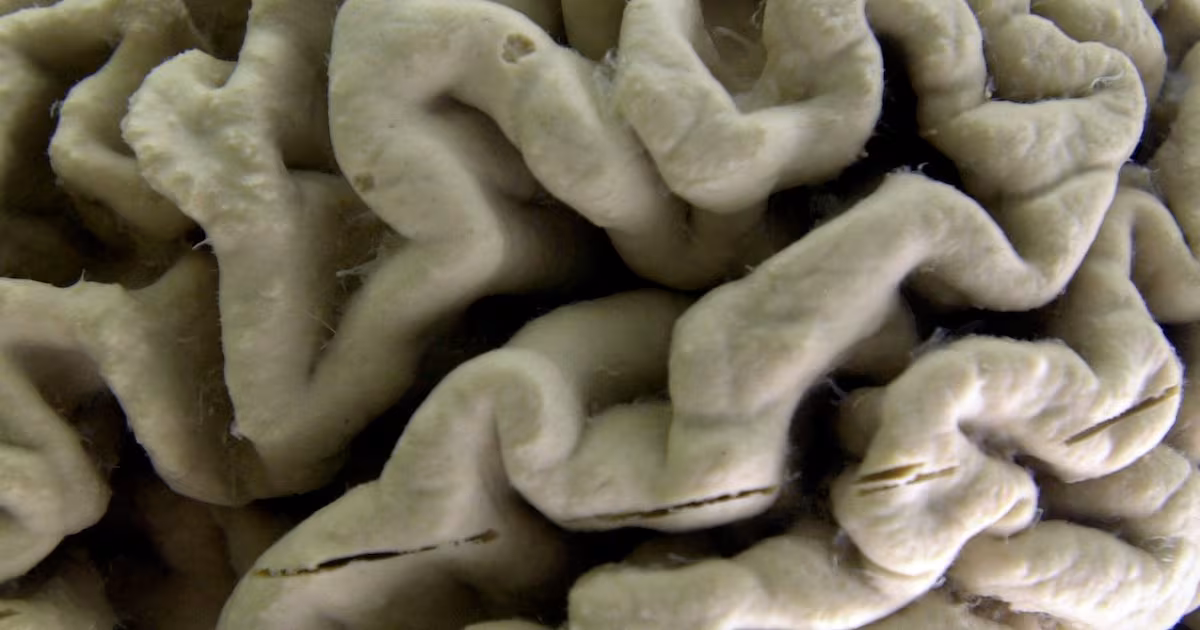 Research links blood test results to early Alzheimer’s