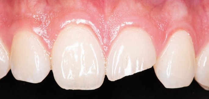 Automating surgical guide design for single anterior implants powered by artificial intelligence