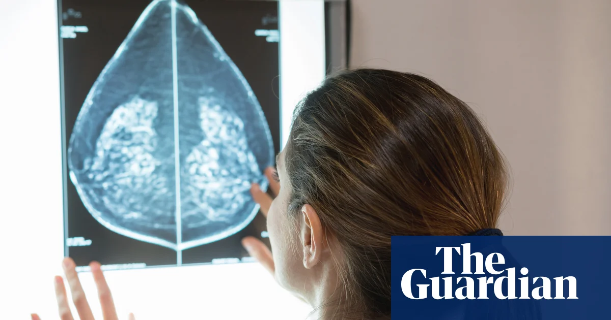 AI can detect heart disease in women using mammograms, study suggests